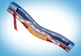 Pooled 2-Year Outcomes of DETOUR Trials Support Percutaneous Transfemoral  Arterial Bypass
