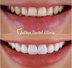 We did not find results for: Dental Implants And Veneers From Turkey Our Prices