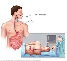 Peptic Ulcer - Diagnosis And Treatment - Mayo Clinic