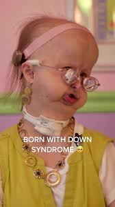 Understanding Down Syndrome: Characteristics and Challenges