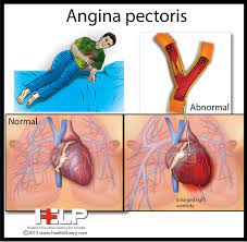 Angina Pectoris Angina Pectoris Nursing Pathophysiology Bsn Nursing