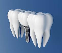 4 Things to Know About Dental Implants - Northside Dental Care, PC Peabody  Massachusetts