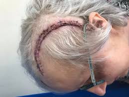 Plymouth mum woke up thinking she was 28 years younger after brain tumour  battle