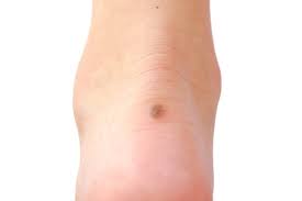 Image result for brown patches on the feet