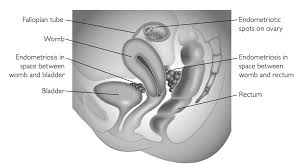 Endometriosis is defined as the presence of normal endometrial mucosa (glands and stroma) abnormally implanted in locations other than the uterine cavity (see the image below). Bowel Endometriosis Chelsea And Westminster Hospital Nhs Foundation Trust