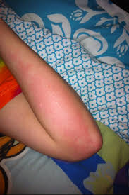 Solar Urticaria Emedicine Cold Urticaria Urticaria Allergic Urticaria