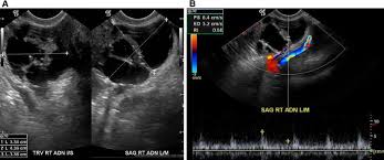 It ranks as the fifth deadliest cancer among women. Ovarian Cancer Mimics How To Avoid Being Fooled By Extraovarian Pelvic Masses Springerlink