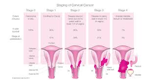 After battling acute cervical cancer symptoms from imbalanced michelle heaton: Symptoms Of Cervical Most Cancers Before Menopause