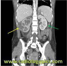 Xanthogranulomatous Pyelonephritis Radiology Imaging Medical Imaging Radiology