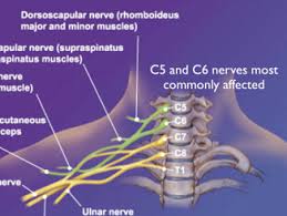 C5 c6 neck pain exercises. Neck Shoulder Arm Pain
