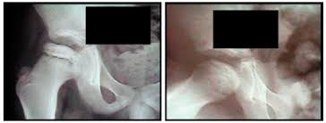 Scielo Brasil Initial Experience Of Use Of An Articulated External Fixator In Treating Legg Calve Perthes Disease By Means Of Arthrodiastasis During The Active Phase Of The Disease Initial Experience Of Use