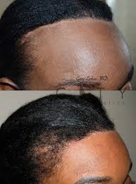 Hair loss can appear in many different ways, depending on what's causing it. Nyc Female Hair Loss Treatment New York Androgenic Alopecia Women