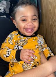 Metopiccraniosynostosis"