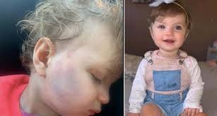 Star Hobson: Photo shows bruised face months before murder