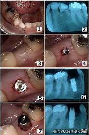 Images after wisdom tooth extraction. Dr Jeffrey Dorfman Dentist