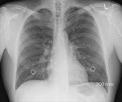 Image result for Pulmonary Contusion