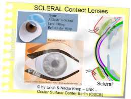 The good news is that due to the structure of the eye, a contact lens can't actually 'get lost' in your eye. Overview Of Contact Lenses Ocular Surface Center Berlin