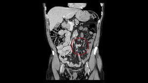 Image result for Volvulus