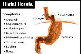 Image result for stomach hernia symptoms