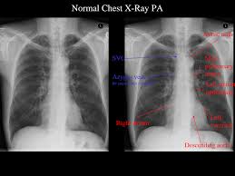 You have completed this module. Https Silo Tips Download Normal Chest X Ray Pa