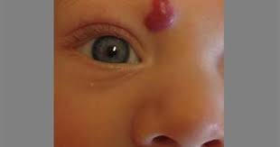 The cause of cherry angiomas is mostly unknown; Infantile Hemangiomas About Strawberry Baby Birthmarks Healthychildren Org