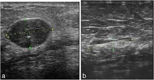 Like standard mammography, tomosynthesis utilizes a paddle to compress the breast to minimize any possible motion as well as minimize the amount of radiation needed to penetrate the breast tissue. Role Of Ultrasound In Predicting The Molecular Subtypes Of Invasive Breast Ductal Carcinoma Egyptian Journal Of Radiology And Nuclear Medicine Full Text