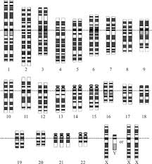 Down Syndrome Wikipedia