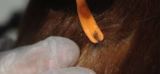 Prévenir l'infection afin de prévenir au mieux l'infection, il est conseillé d'éviter au maximum les zones infestées de tiques, tout particulièrement au printemps et au. La Maladie De Lyme