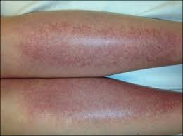 It can occur anywhere in the body but mostly found in lower legs and face. Sunburn Purpura Mdedge Dermatology