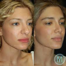 Rhinoplasty In 2020 Rhinoplasty Nose Jobs Nose Plastic Surgery Nose Surgery Rhinoplasty