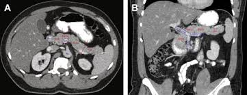 Maybe you would like to learn more about one of these? Imaging And Endoscopic Approaches To Pancreatic Cancer Hematology Oncology Clinics