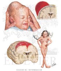 Image result for Cephalhematoma