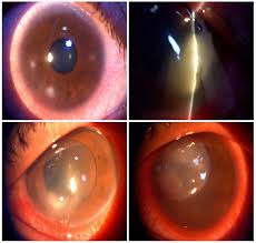 Other viruses need only supportive care such as artificial tear drops. Bacterial Keratitis Infection A Battle Between Virulence Factors And The Immune Response Intechopen