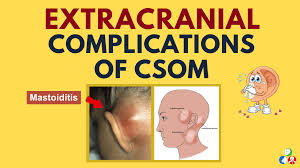 Image result for Mastoiditis