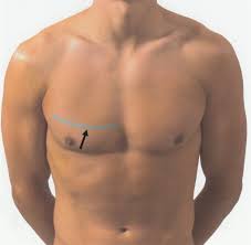 You should be evaluated and have chest xray to find the cause so be treated. Chest Wall Knowledge Amboss