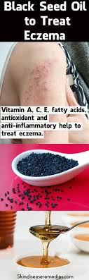 Pin By Mary Hance On Eczema Oils For Eczema Black Seed Oil How To Treat Eczema