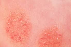 Image result for koebner phenomenon psoriasis