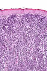 Merkel cells are located deep in the top layer of skin. Largest Genomic Analysis Of Merkel Cell Carcinoma Patients Completed Ecancer