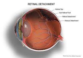 If your retina gets torn, the fluid inside your eye can leak underneath and separate the retina from its underlying tissue. About Retinal Tears Retinal Detachment Gem Clinic Glaucoma Eye Management Cataract Surgery Glaucoma Surgery Laser Surgery In Winnipeg Manitoba Canada
