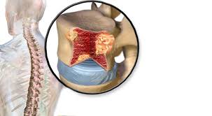 3 people who are older than age 50 or previously had cancer are at an increased risk of developing a cancerous spinal tumor. What To Do After You Are Diagnosed With Spine Tumors