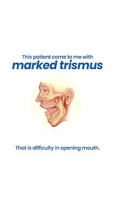 Image result for Trismus