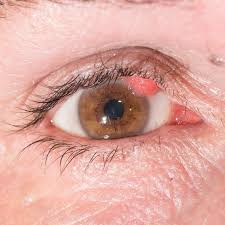Papiloma En Los Ojos Conoce Todos Sus Riesgos Visum