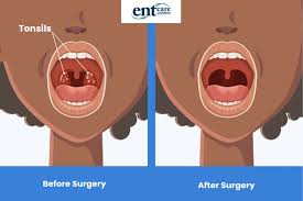 Image result for Tonsillectomy