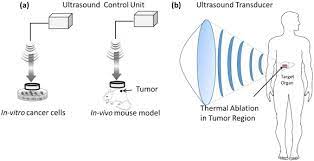 A Review On The Use Of Magnetic Fields And Ultrasound For Non Invasive Cancer Treatment Sciencedirect
