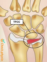 Created 24 december 2013, last modified 29 the triangular fibrocartilage complex (tfcc) is located on the side of the wrist with the bump (the ulnar. Tfcc Injury Physio Check