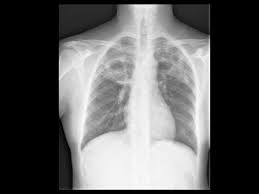 Possible causes, signs and symptoms, standard treatment options and means of care and support. Tuberculosis Cancer Therapy Advisor