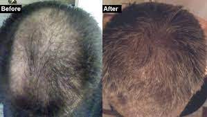 The brown algae, ecklonia cava contains dioxinodehydroeckol, which promotes hair growth through the. Aside From Rogaine And Finasteride How Can I Regrow And Thicken My Ha Nature Crazy Llc