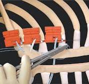Arthrex - Sistema de fechamento esternal FiberTape®