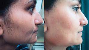 Testosterone is a male hormone, called an androgen, which is present in higher levels in women with pcos. Permanent Hair Removal Options For Women With Pcos Peach Clinics