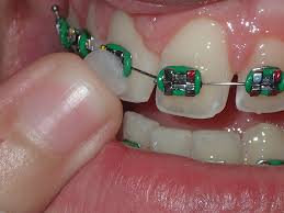 Please subscribe to our channel to get more videos like this. Emergencies Creative Orthodontic Associates